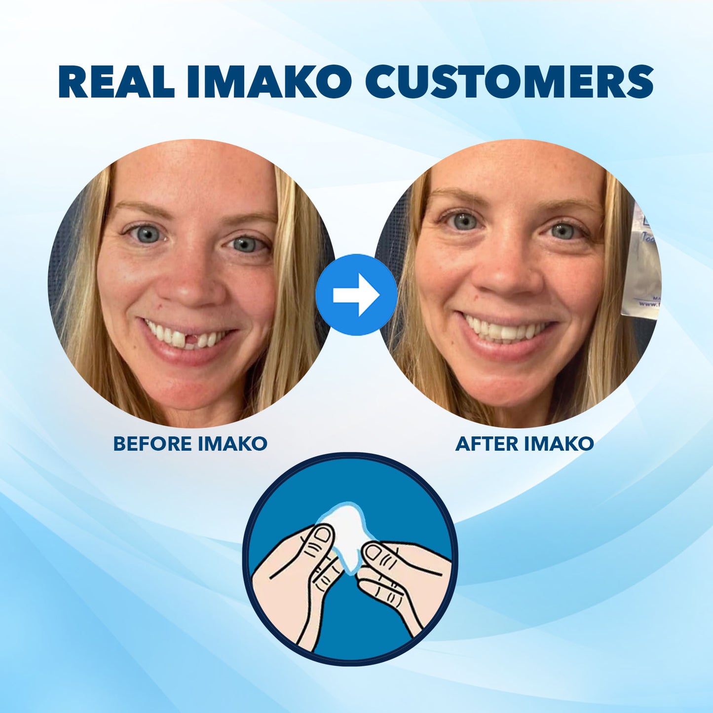 Imako® Tooth Tinted Plastic – Temporary Tooth – For Chipped Tooth & Fill Gaps in Teeth