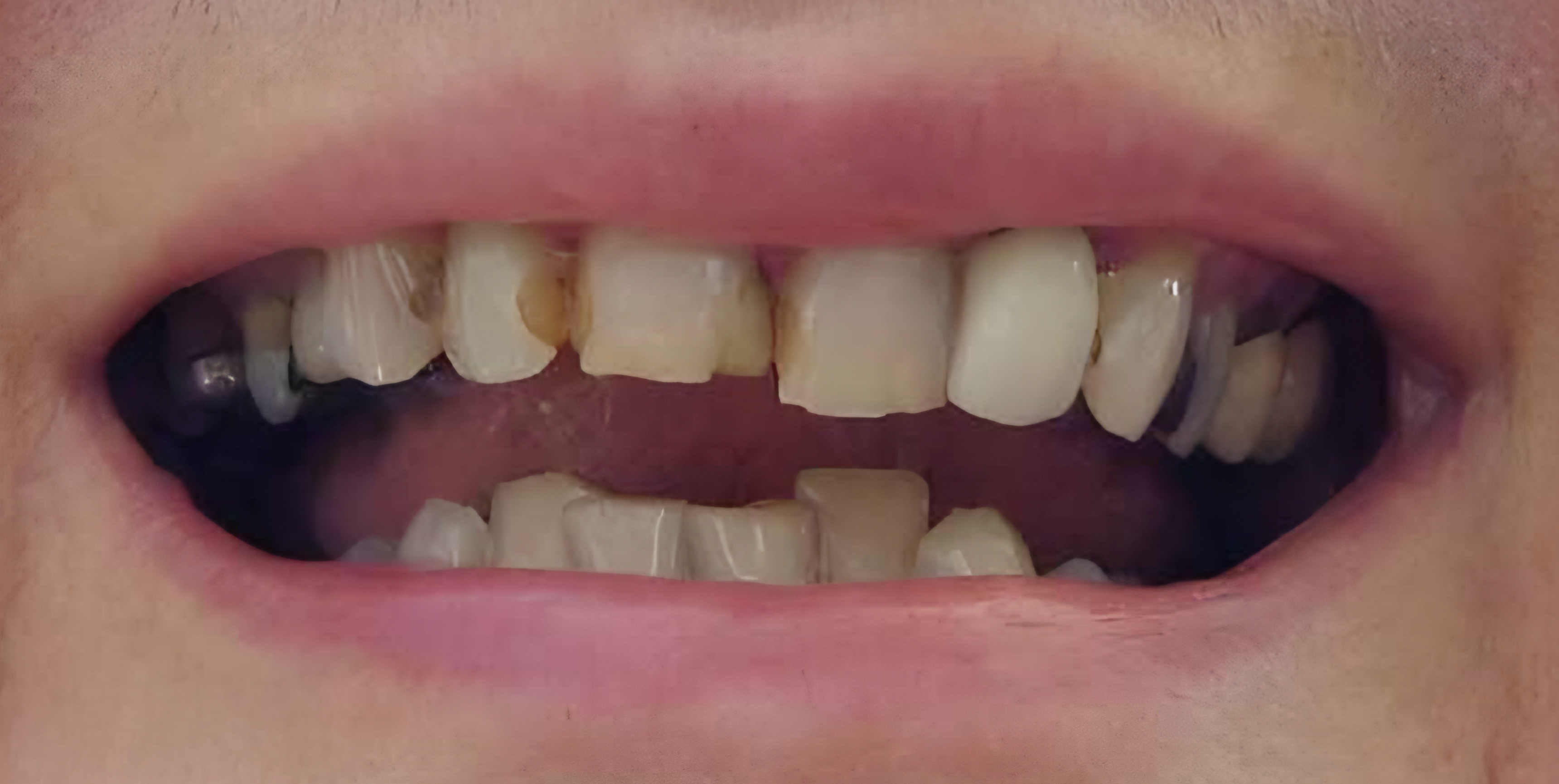 Before Imako® Cosmetic Teeth – Tooth Stains and Decay Visible Smile showing visible tooth stains and decay before using Imako® Cosmetic Teeth.