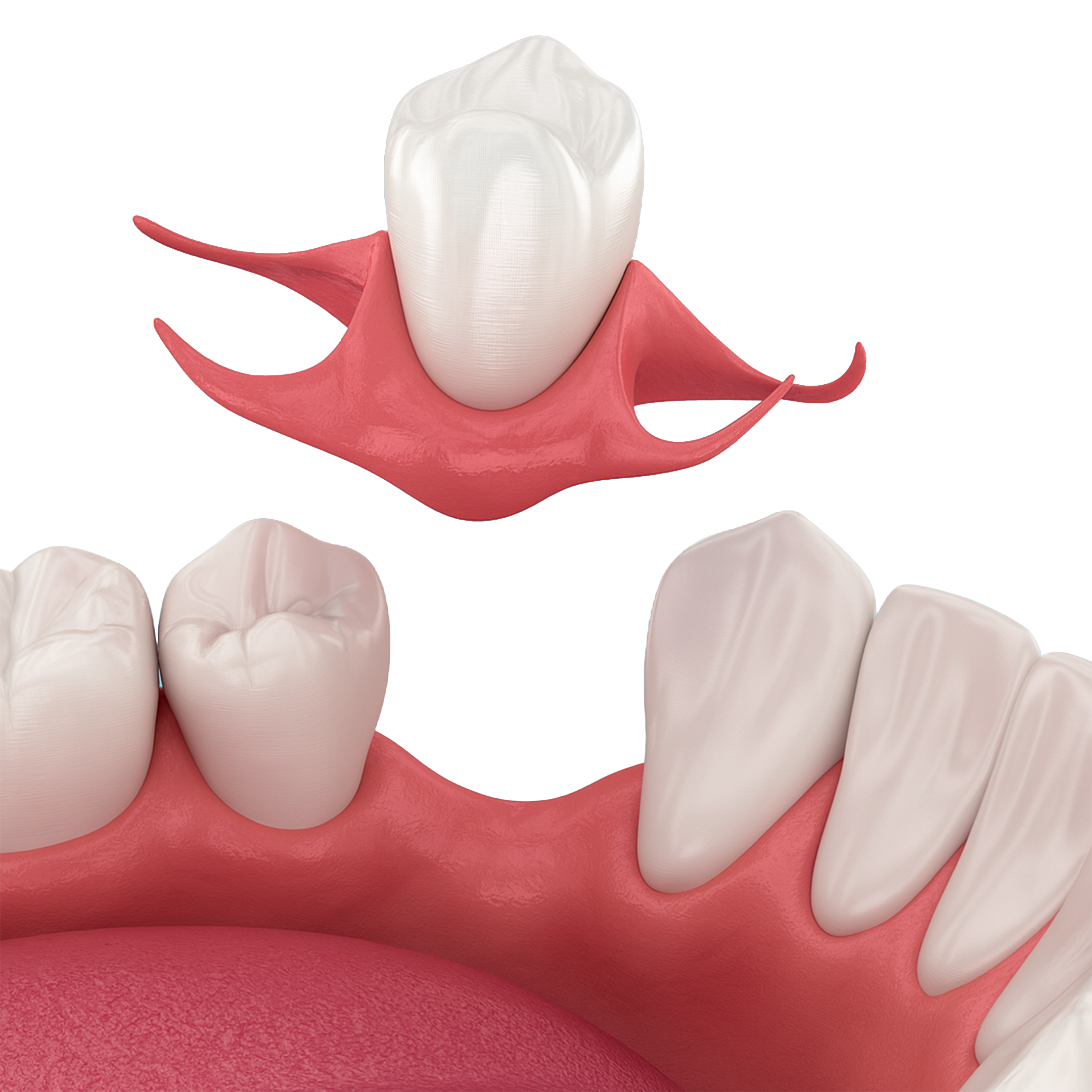 Woman fitting Imako® Cosmetic Teeth over her natural smile for a quick cosmetic enhancement.