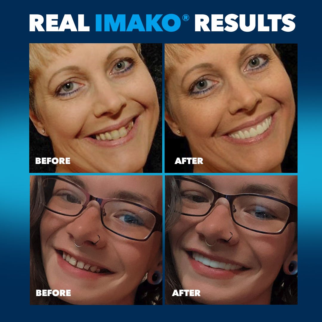 Imako® Cosmetic Teeth – Refill Kit - Imako