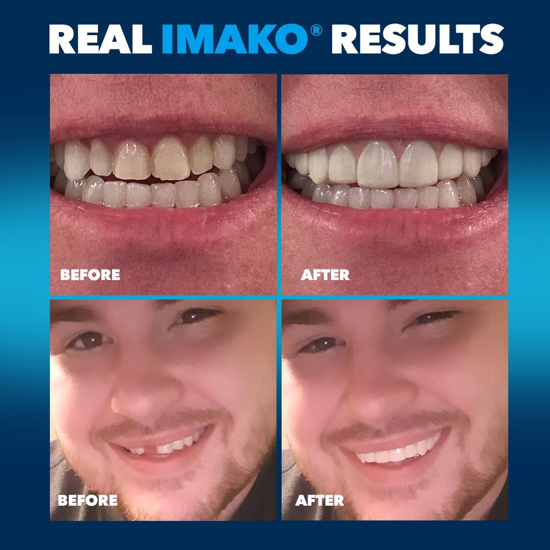 Imako® Cosmetic Teeth – Refill Kit - Imako